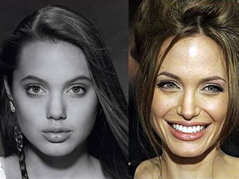 Plastic Surgery Before And After Angelina Jolie
