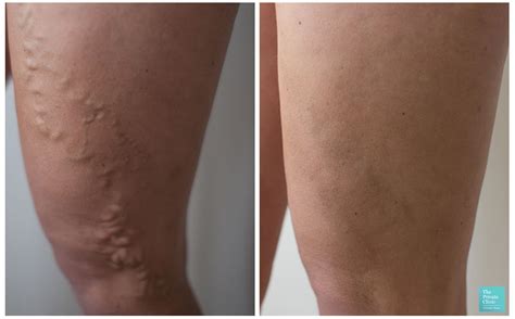 Varicose Vein Treatments Launch At The Private Clinics Buckinghamshire