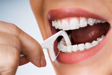 Straightening Your Smile Essential Tips For Caring For Your Braces
