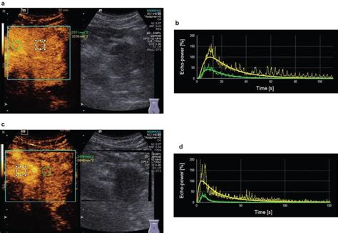 The Value Of Dynamic Contrast Enhanced Ultrasound Dce Us In