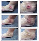 Best Treatment For Venous Stasis Ulcers