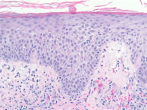 Seborrheic Dermatitis Histology