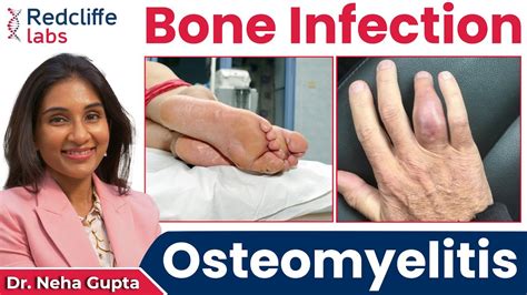 What Is Osteomyelitis Osteomyelitis Bone Infection Symptoms
