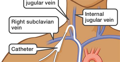 Central Venous Line Cvl Insertion Into The Internal Jugular Vein