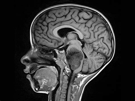 Brain Tumor In The Brain Stem Brain Tumor Cancer