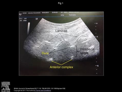 Real Time Ultrasound Guided Paramedian Spinal Anaesthesia Evaluation