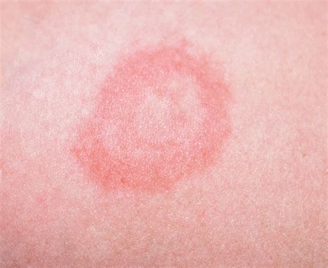 Skin Rashes In Children On Face In Adults On Hands On Arms That Itch In