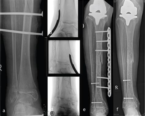 A Novel Technique For Treatment Of Peri Implant Tibial Shaft Fracture With Pre Existing