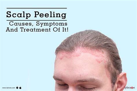Scalp Peeling And Acne Causes And Treatments Heidi Salon