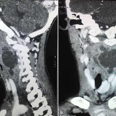 Ct Scan Of The Neck Showing Retropharyngeal Abscess Obstructing The