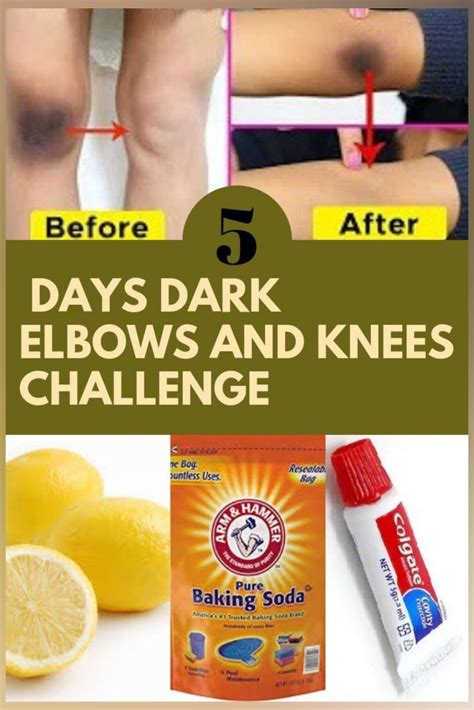 7 Natural Ways To Lighten Dark Knees And Elbows At Home In 2021 Dark