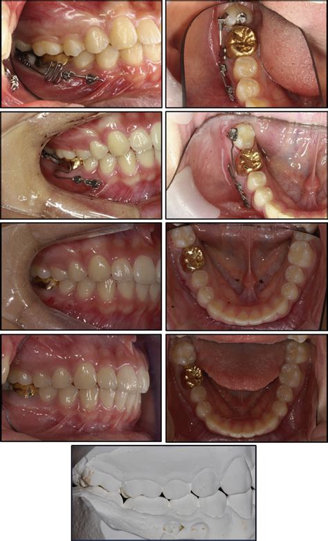 Uprighting Mesially Impacted Mandibular Molars With 2 Miniscrews