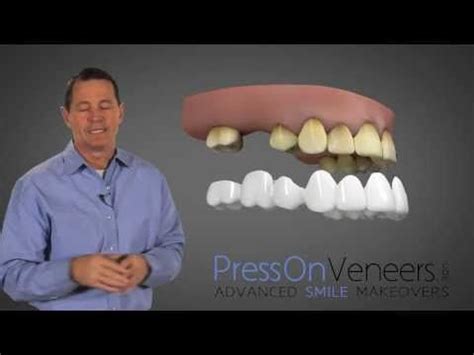 My temporary dental bridge came out and i need to know what adhesive i can use to keep it in place until i see the dentist in dental bridge adhesive? Don't Buy DENTURES | You have another Choice | Cheap dentures, Snap on smile, Dental bridge