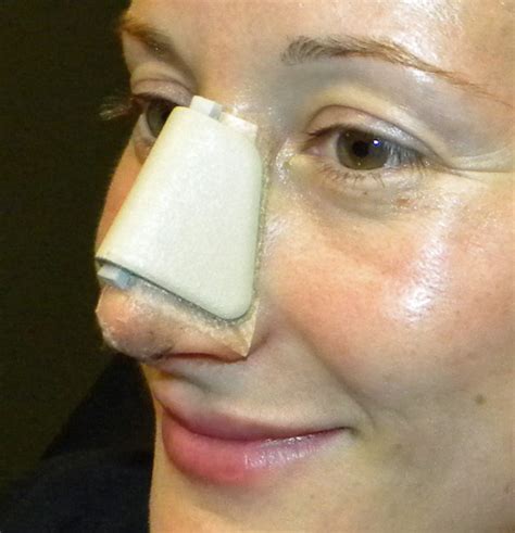 Rhinoplasty Taping And Nasal Splint Dr Barry Eppley Indianapolis
