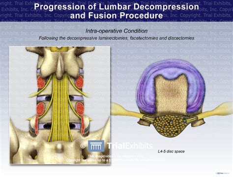 Progression Of Lumbar Decompression And Fusion Procedure Trial