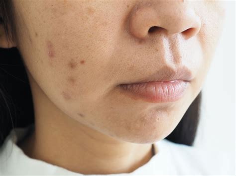 How To Treat Pimples That Cause Hyperpigmentation Justinboey
