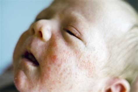 Red Spots On Baby Face
