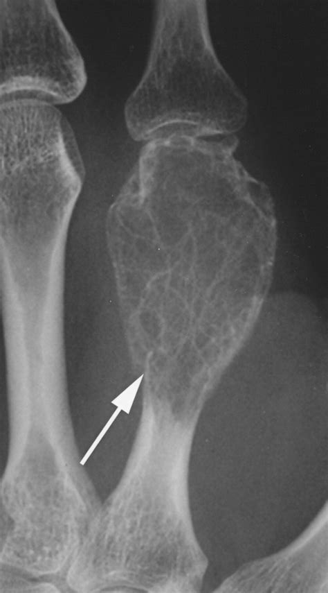 Mimics On Radiography Of Giant Cell Tumor Of Bone Ajr