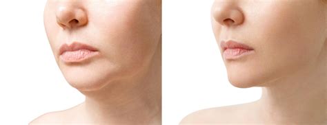 Double Chin Reduction Best Aesthetic Treatments Skinpase Pala