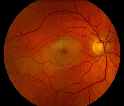 Atlas Entry Hollenhorst Plaque With Branch Retinal Artery Occlusion