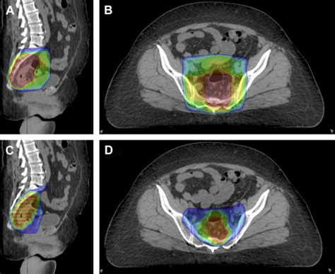 Evolving Role Of Radiotherapy In The Management Of Rectal Carcinoma