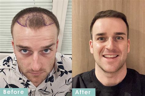 Hair Transplant Before And After Images Hair Transplantation Images