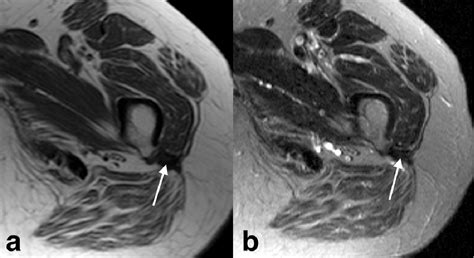 MRI Findings In Gluteus Maximus Tendinopathy The Forgotten Enthesis