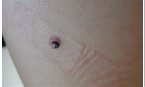 Does Nodular Melanoma Look Like A Blood Blister Best Reviews