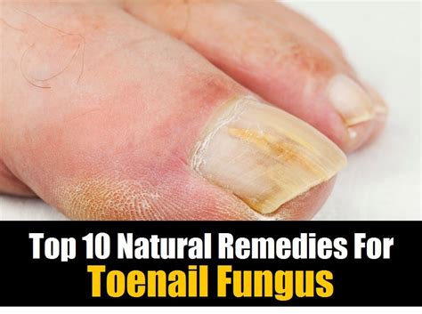 Top 10 Natural Remedies For Toenail Fungus ~ Mzizi Mkavu