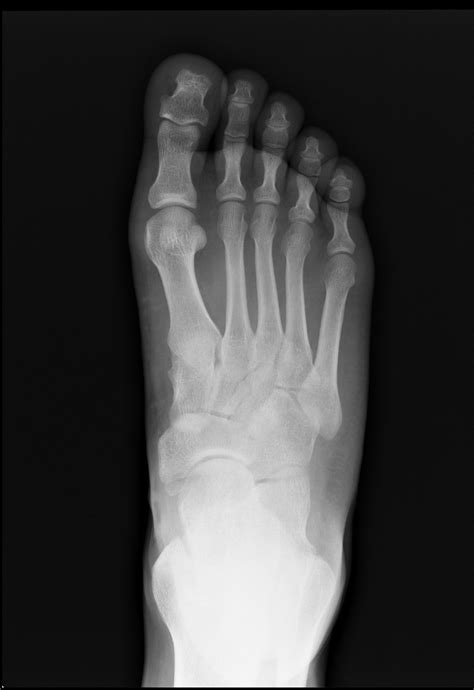 Podiatrist In Akron Hallux Rigidus In Akron Green Foot And Ankle Care