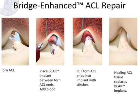 New Acl Repair Technique For The Future Acl Surgery Acl Tear Acl
