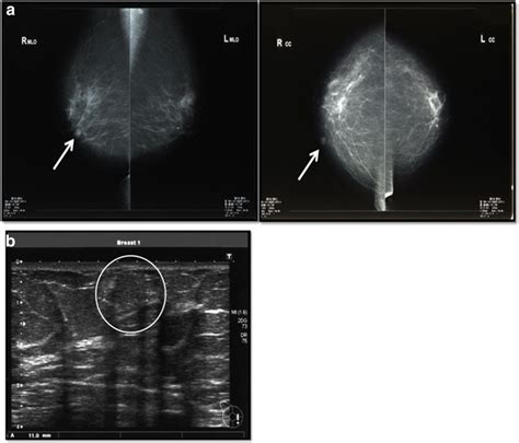 A Mammography Revealed A Circumscribed High Density Lobular Nodule A