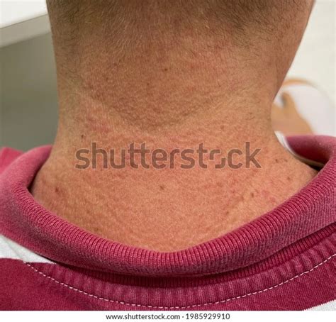 Multiple Illdefine Erythematous Patch Posterior Side Stock Photo