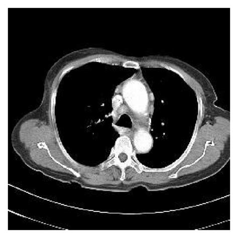 A A Follow Up Chest Ct After 3 Cycles Of Abvd Chemotherapy Shows