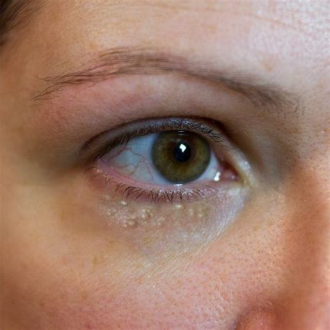 How To Get Rid Of Milia Under The Eye With Images Bumps Under Eyes