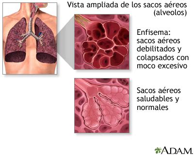 Enfermedad pulmonar obstructiva crónica EPOC MedlinePlus enciclopedia médica illustración