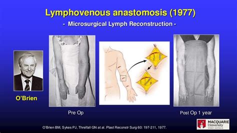 Surgical Treatment Of Secondary Lymphoedema—algorythimic Approach At