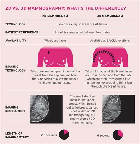 Breast Imaging 3d Mammography Tomosynthesis Breast Imaging Ucla