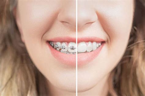 Post Braces Maintenance Keep Your Smile Aligned Gaston Orthodontics