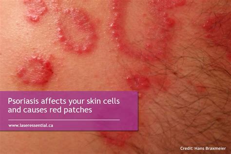 What You Need To Know About Psoriasis Laser Essential And Skin Care