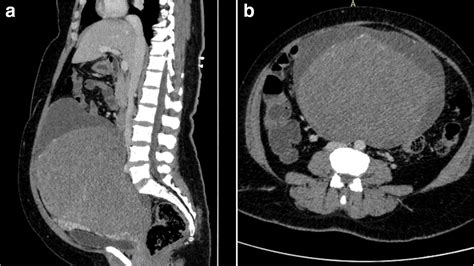 An Unusual Presentation Of A Large Cervical Fibroid—case Report
