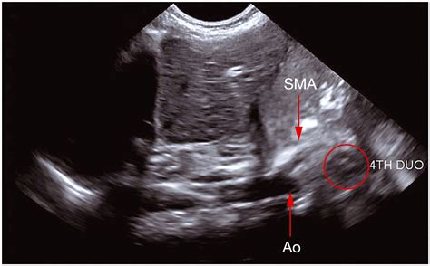 Ultrasound‐guided Positioning Of Transpyloric Feeding Tubes In