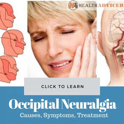 What Is Occipital Neuralgia Occipital Neuralgia Causes Symptoms And