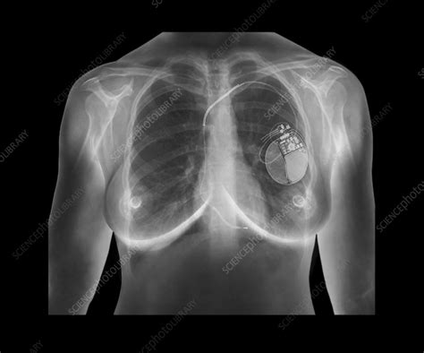Maybe you would like to learn more about one of these? Pacemaker, X-ray - Stock Image - C021/2269 - Science Photo Library