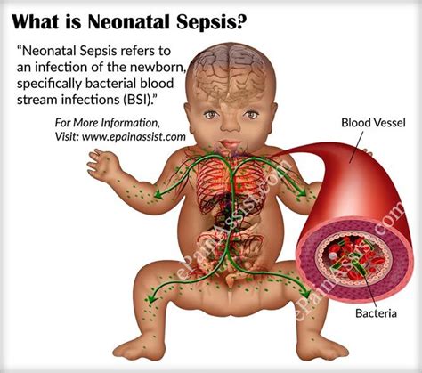 Pin On Sepsis