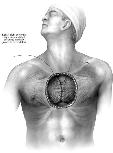 References In Anterior Chest Wall Resection And Reconstruction