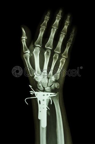 Film X Ray Wrist Ap Show Fracture Distal Radius Forearms Stock Photo