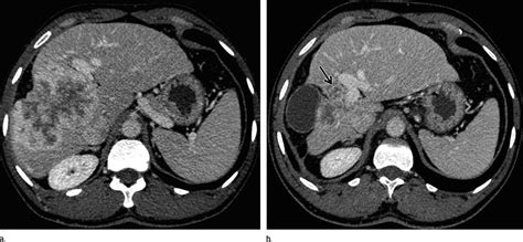 Figure 7 Axial Contrast Enhanced Ct Images In A 39 Year Old Man With