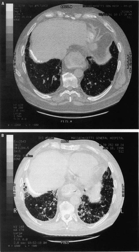 High Resolution Computed Tomography Hcrt Scans Obtained In A 1991
