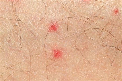 Pinpoint Red Dots On Skin Causes Tdfreeloads